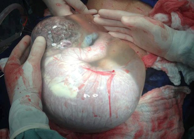 Bayi Lahir masih dalam Kantong Ketuban... Subhanallah